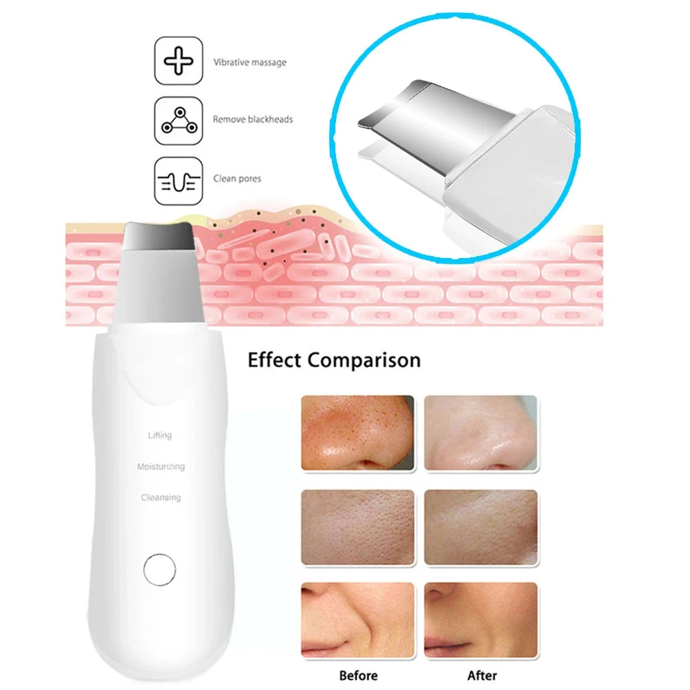 Ultrasonic Facial Skin Scrubber